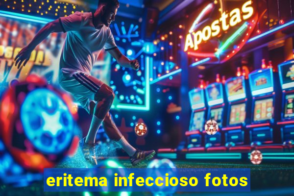 eritema infeccioso fotos